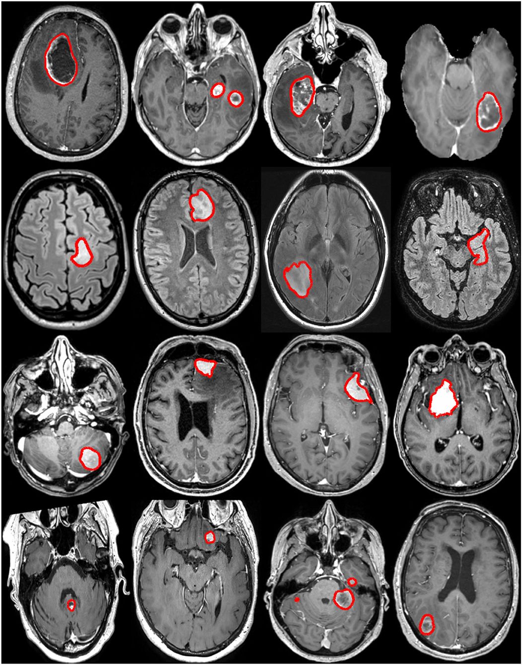 cat scan brain tumor