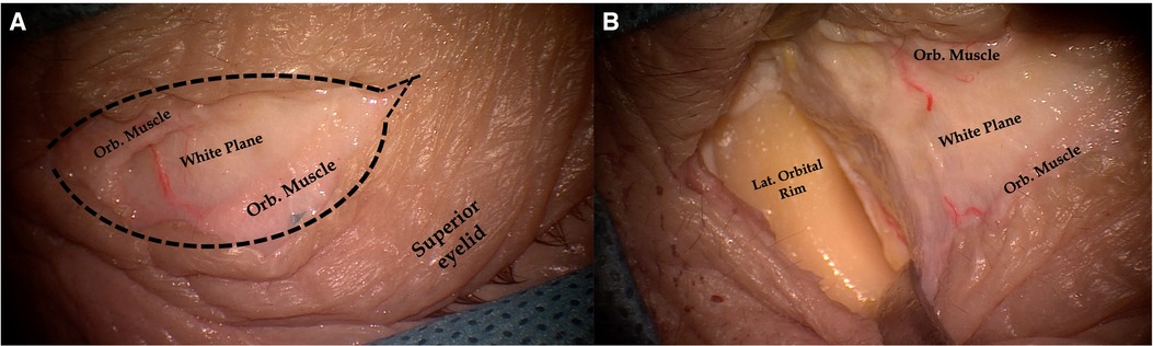 Frontiers | Superior eyelid endoscopic transorbital approach