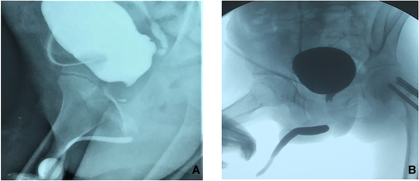 Frontiers | The surgical techniques of transperineal
