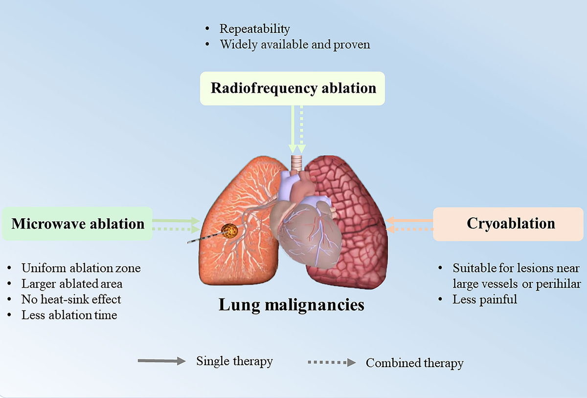 Frontiers | Image-guided percutaneous ablation for lung