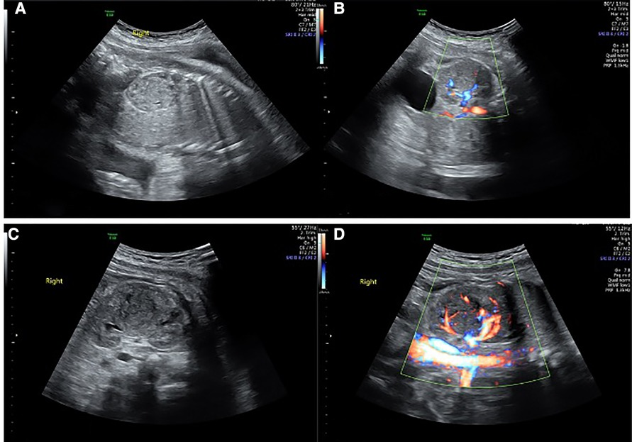 Frontiers Prenatal diagnosis and postnatal management of congenital