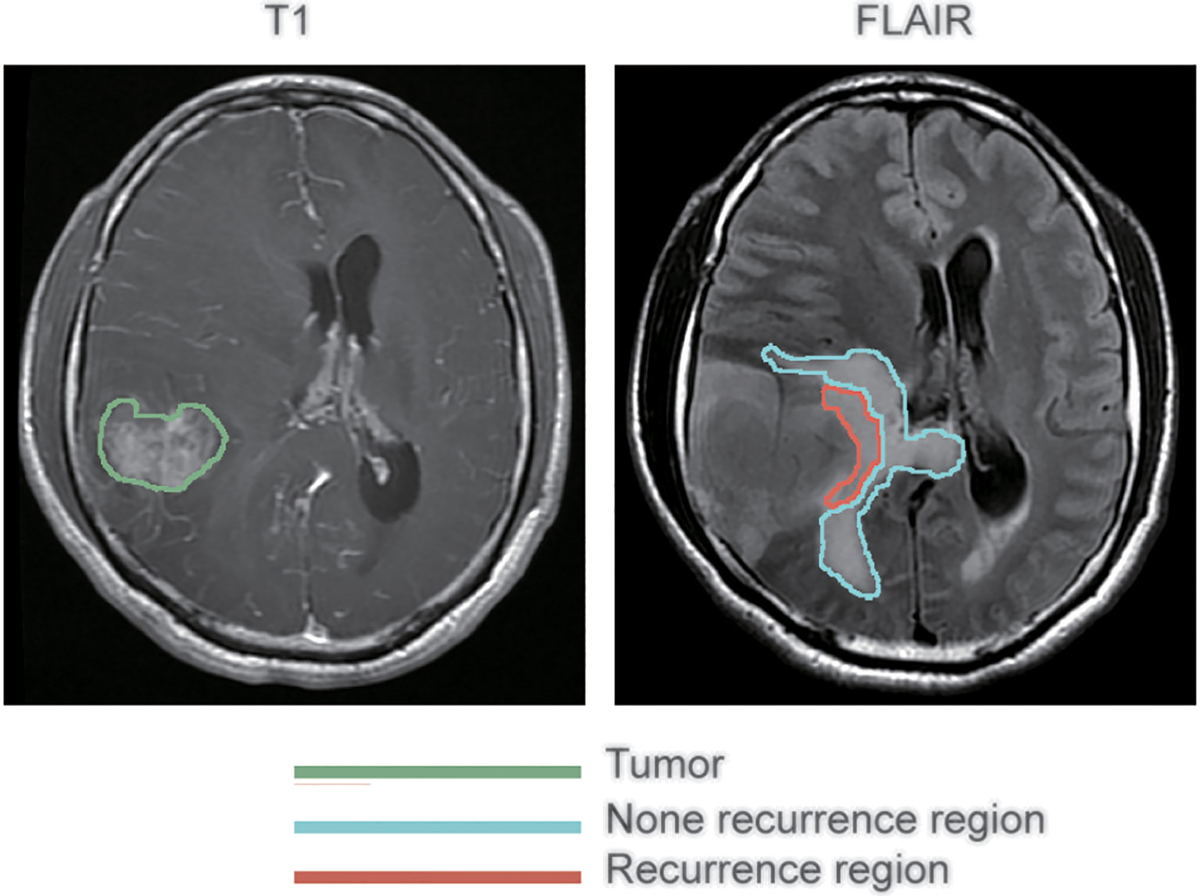 Frontiers | MRI radiomic features of peritumoral edema may