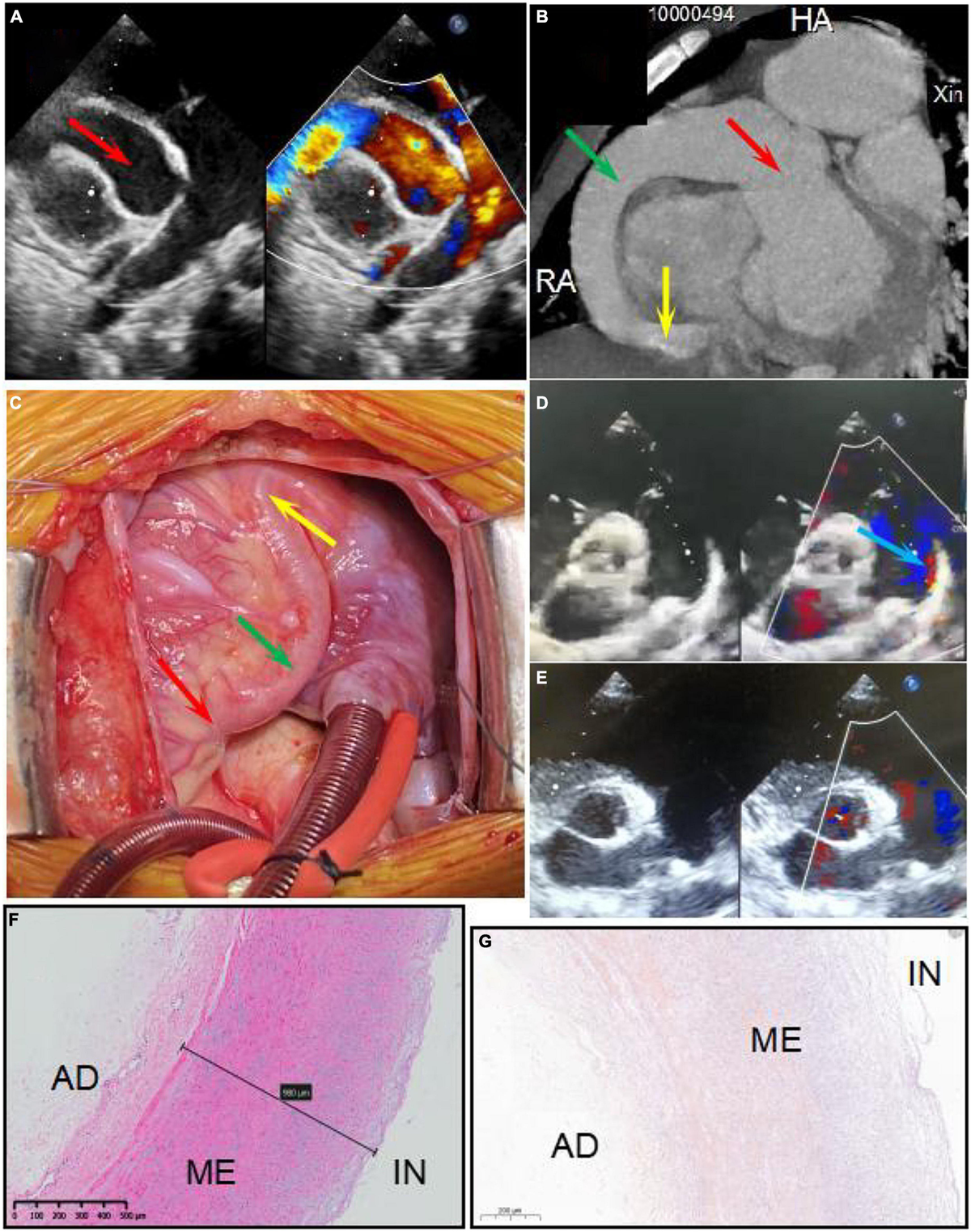 Two genetic variants in NEXN and ABCC6 genes found in a patient with right  coronary artery to right ventricle fistula combined with giant coronary  aneurysm and patent ductus arteriosus - Frontiers
