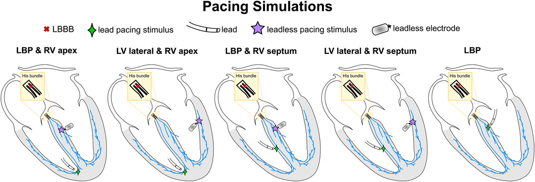 Frontiers | Leadless biventricular left bundle and