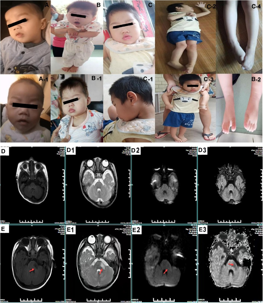 Frontiers | Characteristics of Allan-Herndon-Dudley Syndrome