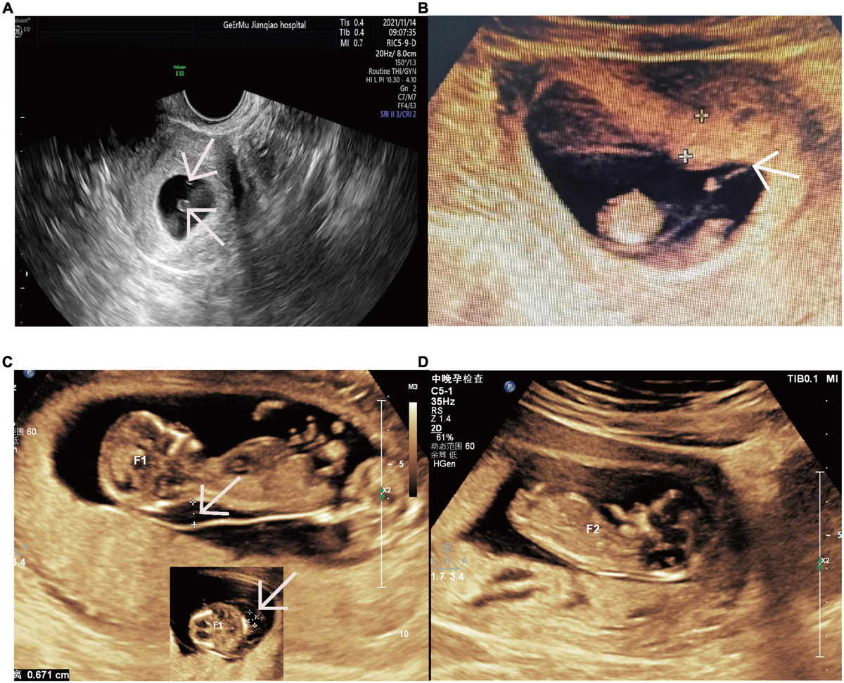 Frontiers | Determining the cause of intrauterine fetal death in  monochorionic twins: A case report