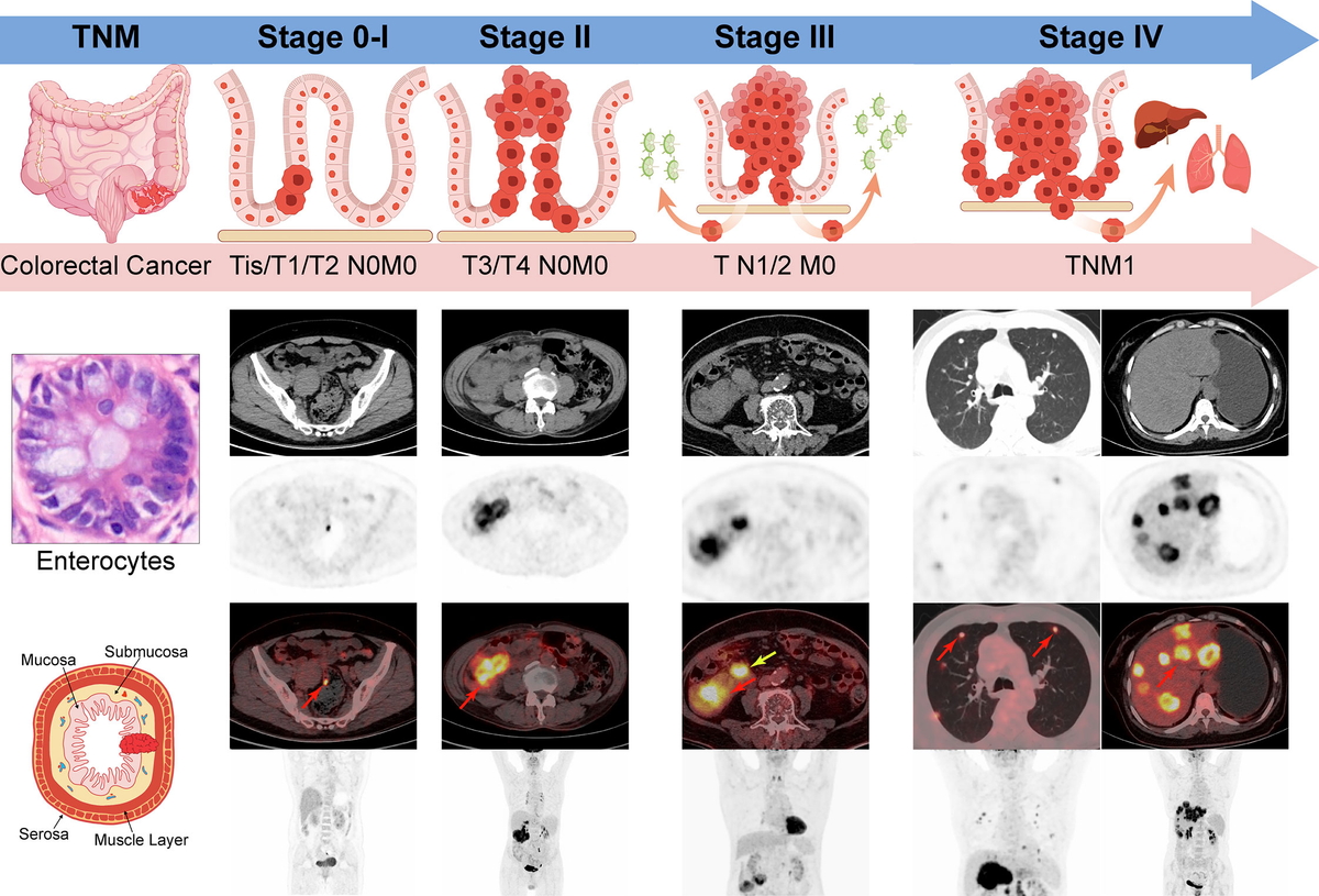 Frontiers | Tailoring the clinical management of colorectal