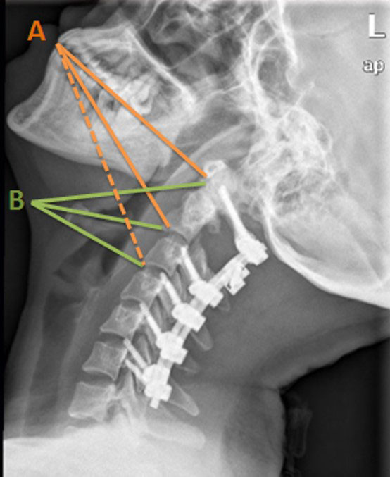 Two-level total disc replacement with Mobi-C cervical