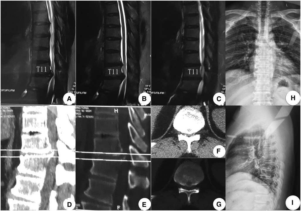 Frontiers A modified percutaneous transforaminal endoscopic surgery