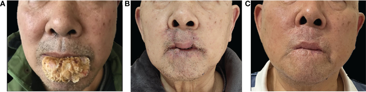 郵送買取 新品5台以上送料無料キャンペーン中！！  huge A | Frontiers verrucous lip lower the of carcinoma その他