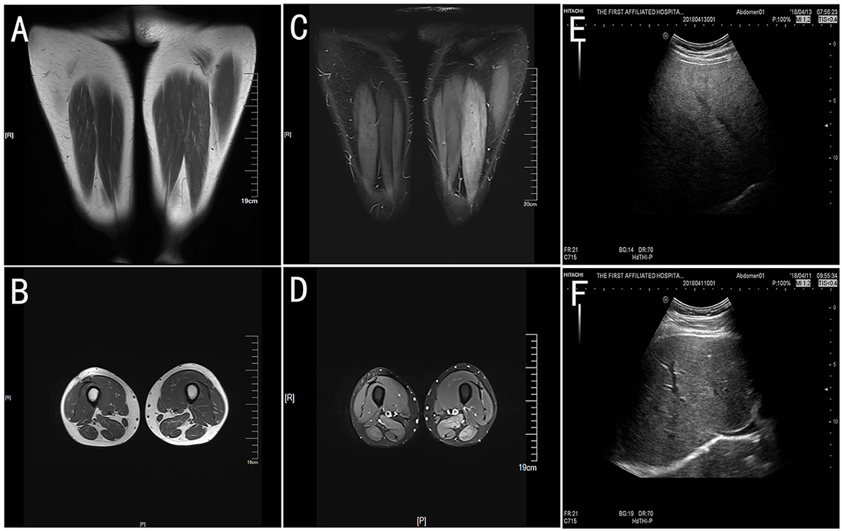 Frontiers | Case report: Novel ETFDH compound heterozygous