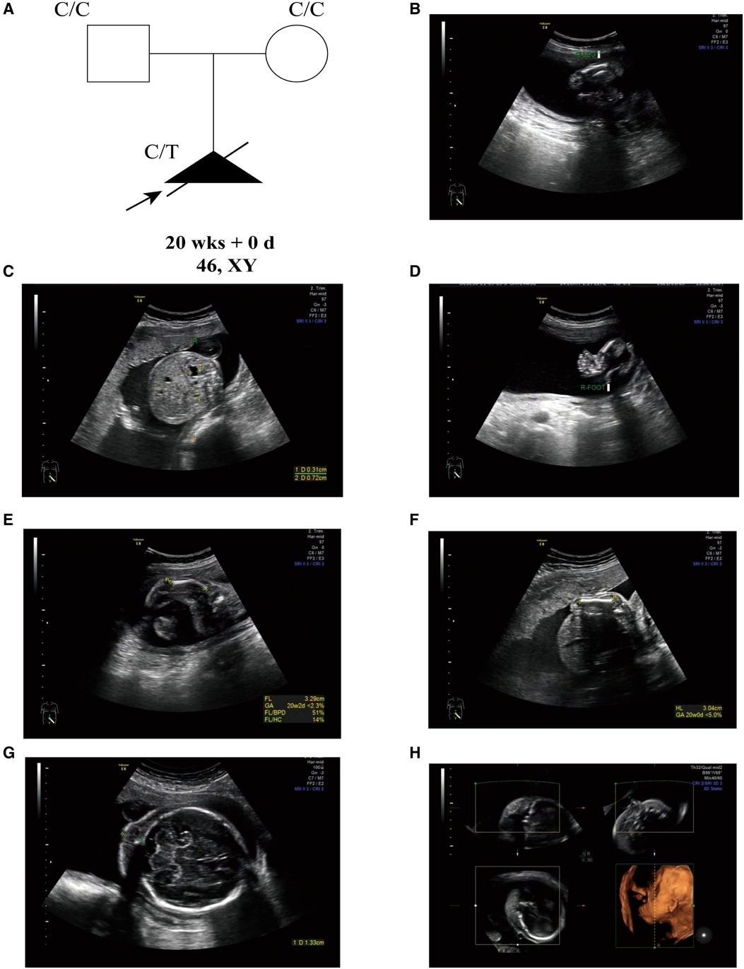 Frontiers | Case report: A de novo Non-sense SOX9 mutation
