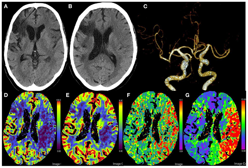 ENCYCLOPAEDIA of OCCLUSION【裁断済】 Frontiers | Mechanical thrombectomy for acute multivessel