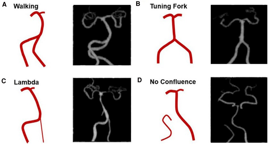 Frontiers | GSI CTA evaluation of the vertebrobasilar artery