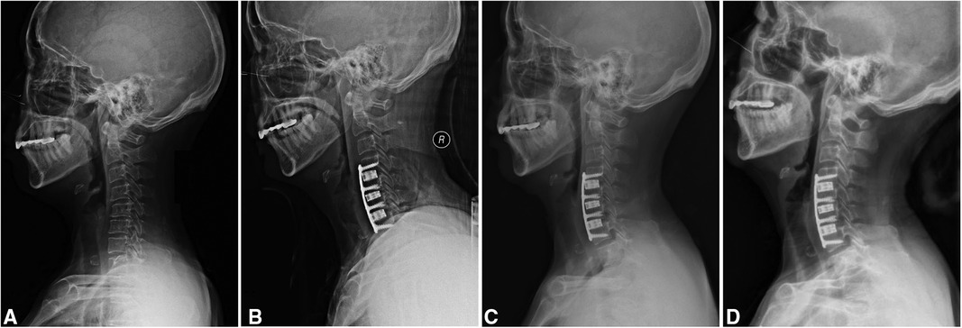 Frontiers | Is 3D-printed Titanium cage a reliable option