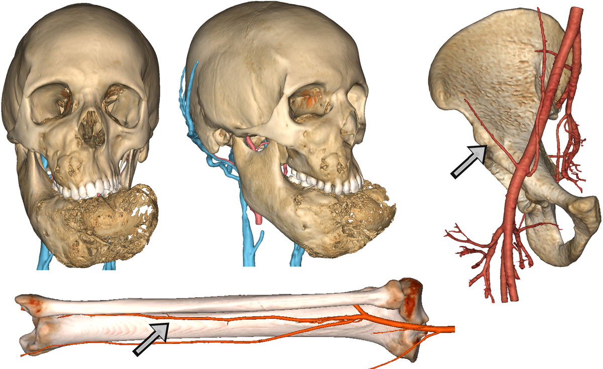 Frontiers | Double osseous flaps for simultaneous midfacial