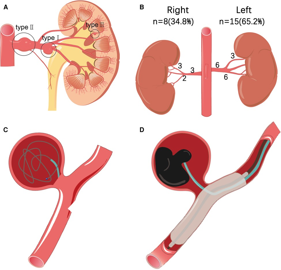 Frontiers Eighteen Cases Of Renal Aneurysms Clinical Retrospective frontiers-eighteen-cases-of-renal-aneurysms-clinical-retrospective