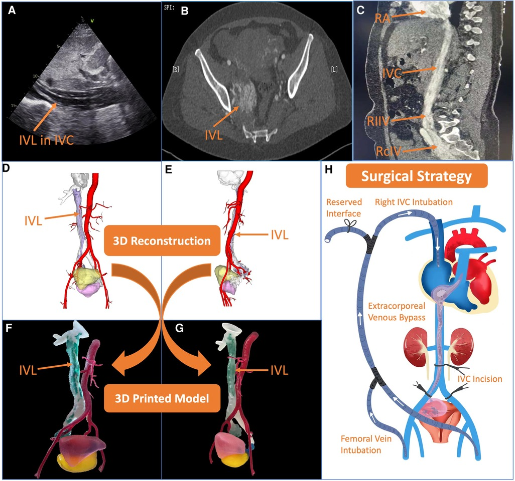 Frontiers Case report Cardiac metastatic uterine intravenous