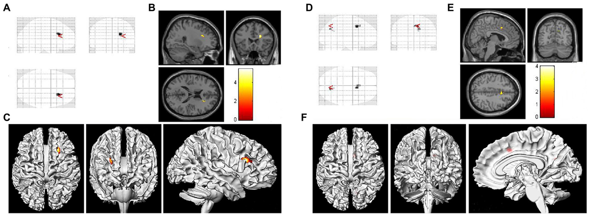 Frontiers | Examination of brain area volumes based on voxel