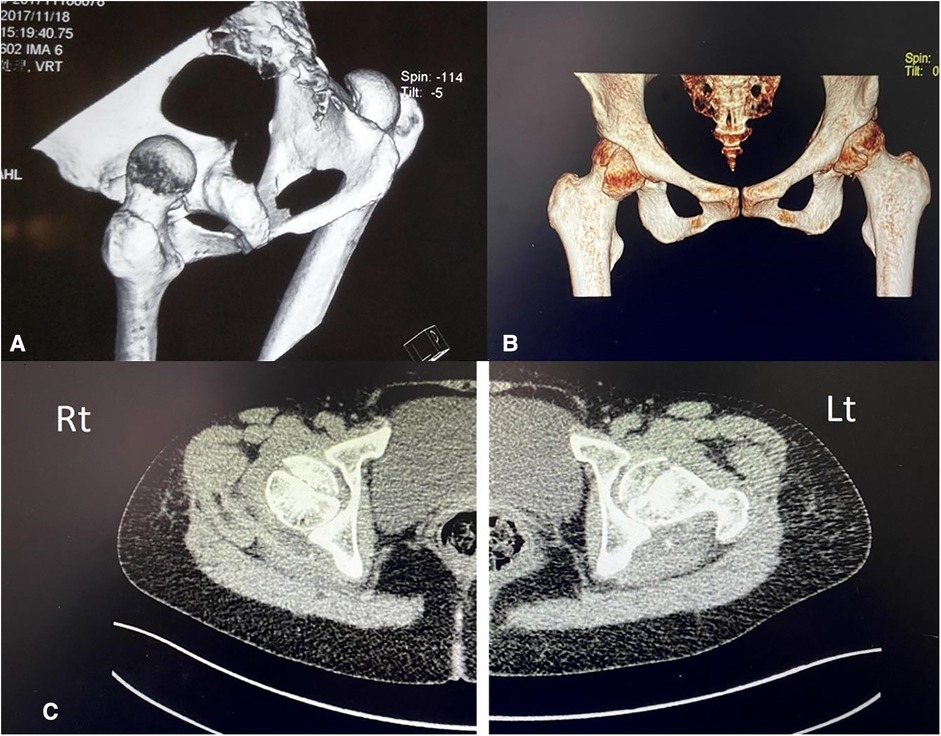 Frontiers | Surgical treatment and functional outcome of