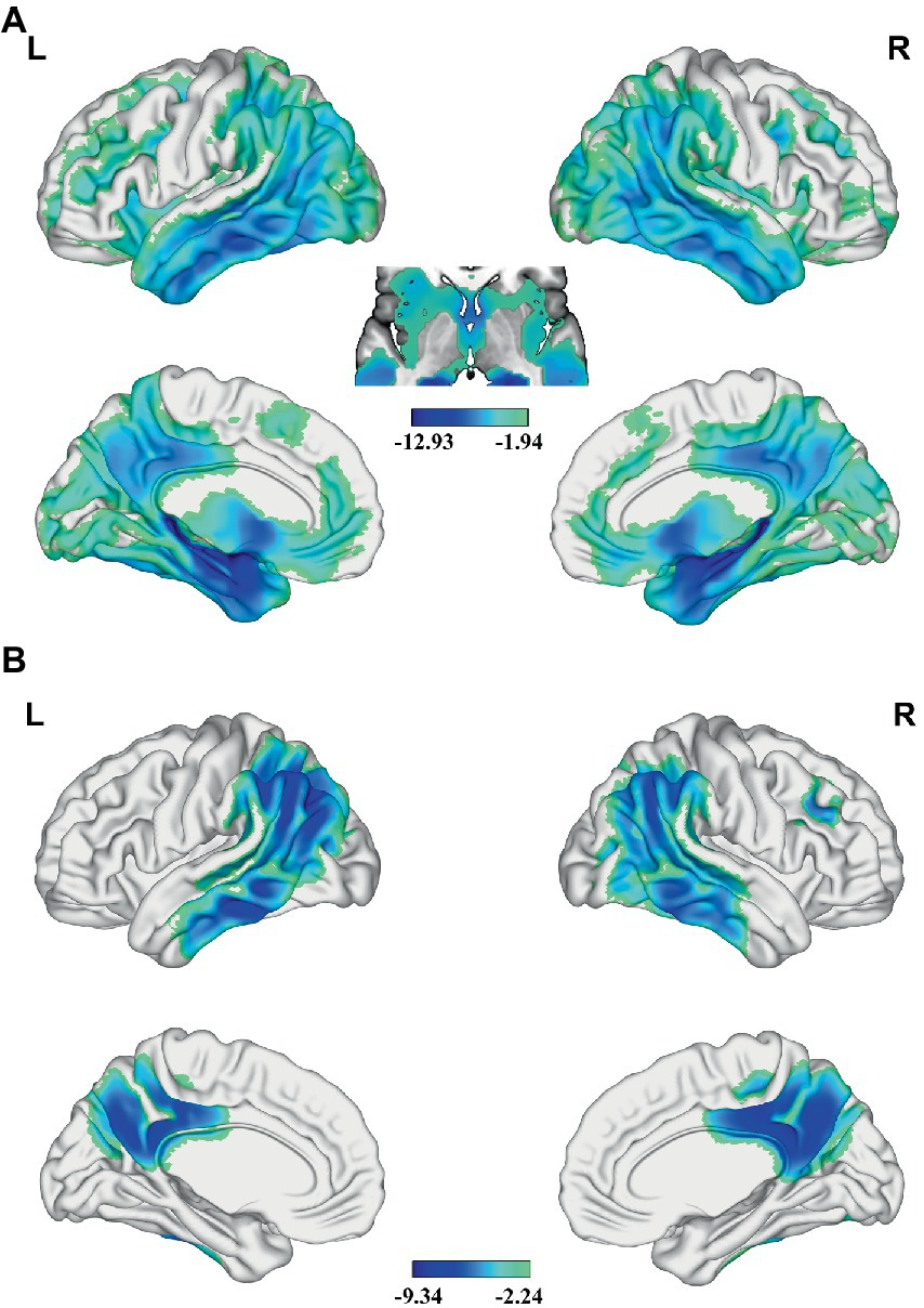 Frontiers | Association between gray matter atrophy