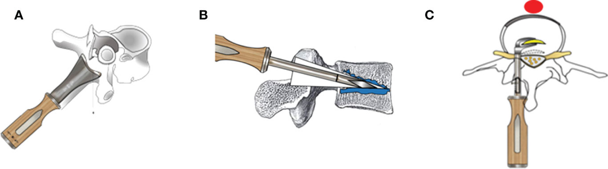 TRUMATCH™ Graft Cage – Long Bone | Products | DePuy Synthes