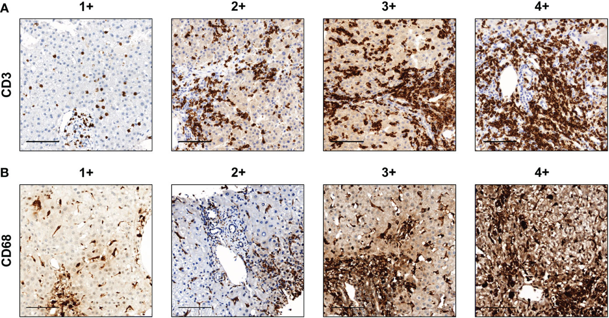 Frontiers | Intrahepatic infiltration of activated CD8+ T cells and ...