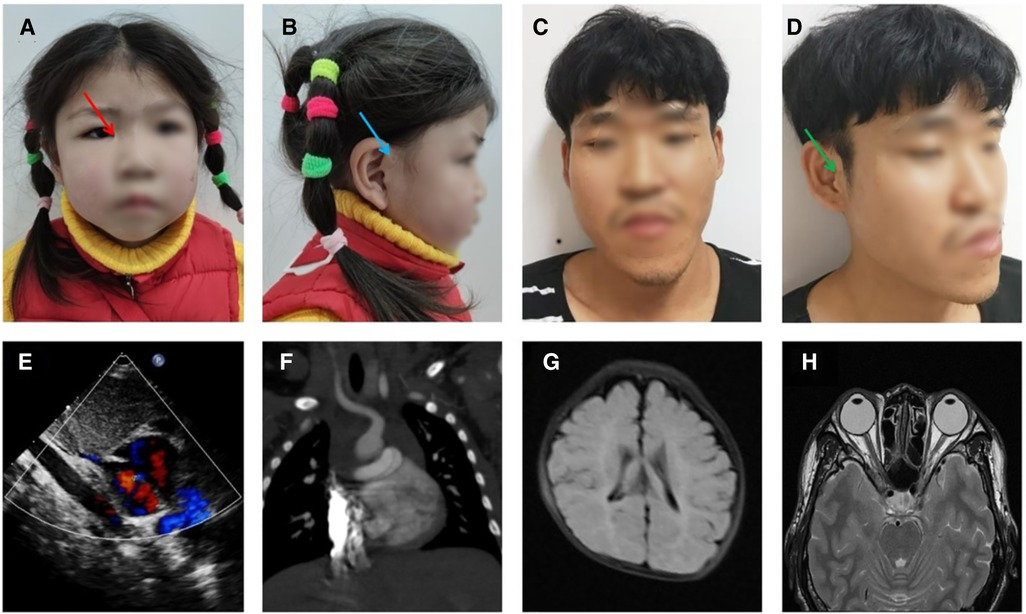 BLUE SYNDROME ドスベロ Frontiers | A Chinese family with cat eye syndrome and