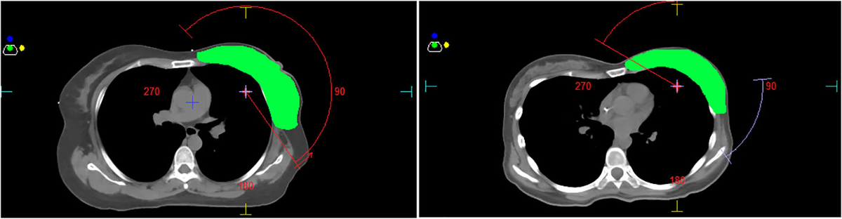 健康・医学 Radiotherapy Techniques in Breast Cancer Master Breast Radiation Planning: Simple Guide for Radiation
