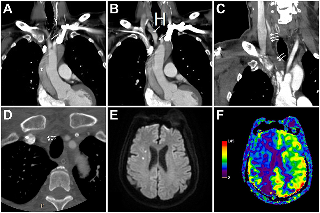 Frontiers | Case report: A hybrid open and endovascular