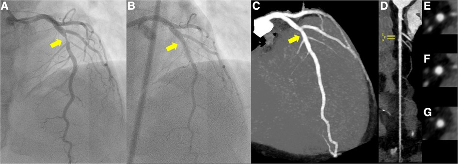 Frontiers | Percutaneous coronary intervention for a healed Frontiers | Percutaneous coronary intervention for a healed
