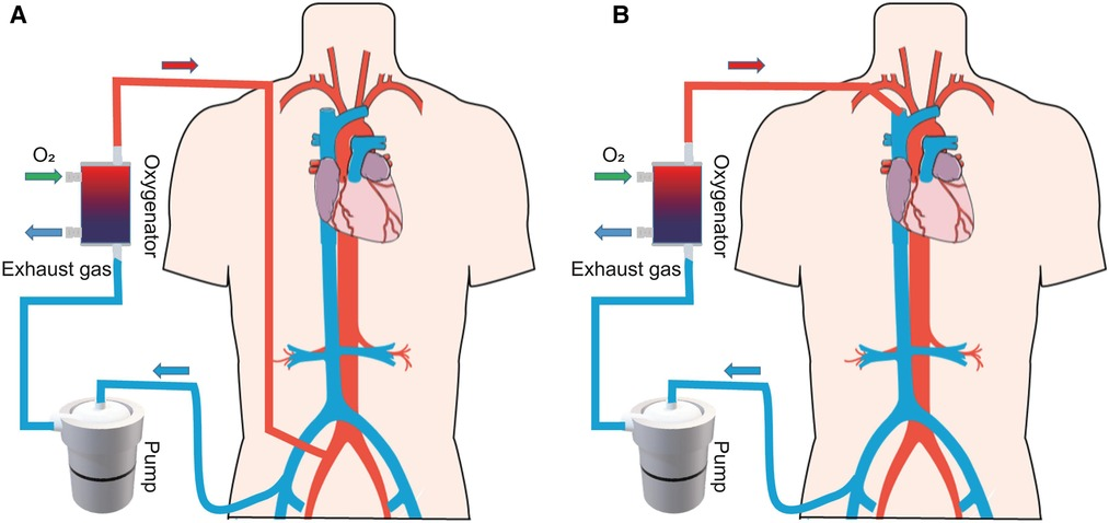 ECMO・PCPSバイブル | 一般社団法人日本呼吸療法医学会/日本経皮