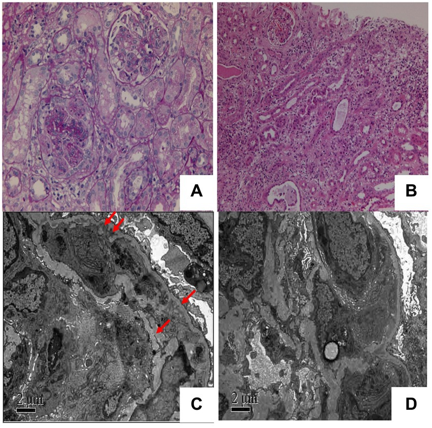 Frontiers | IgM kappa proliferative glomerulonephritis with