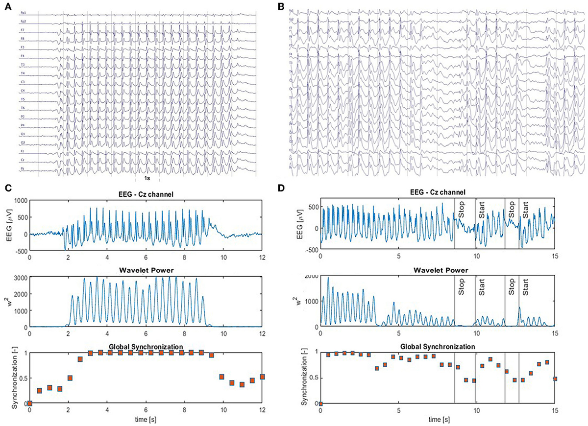 eeg 2007年 Focal Motor Seizures | Neupsy Key