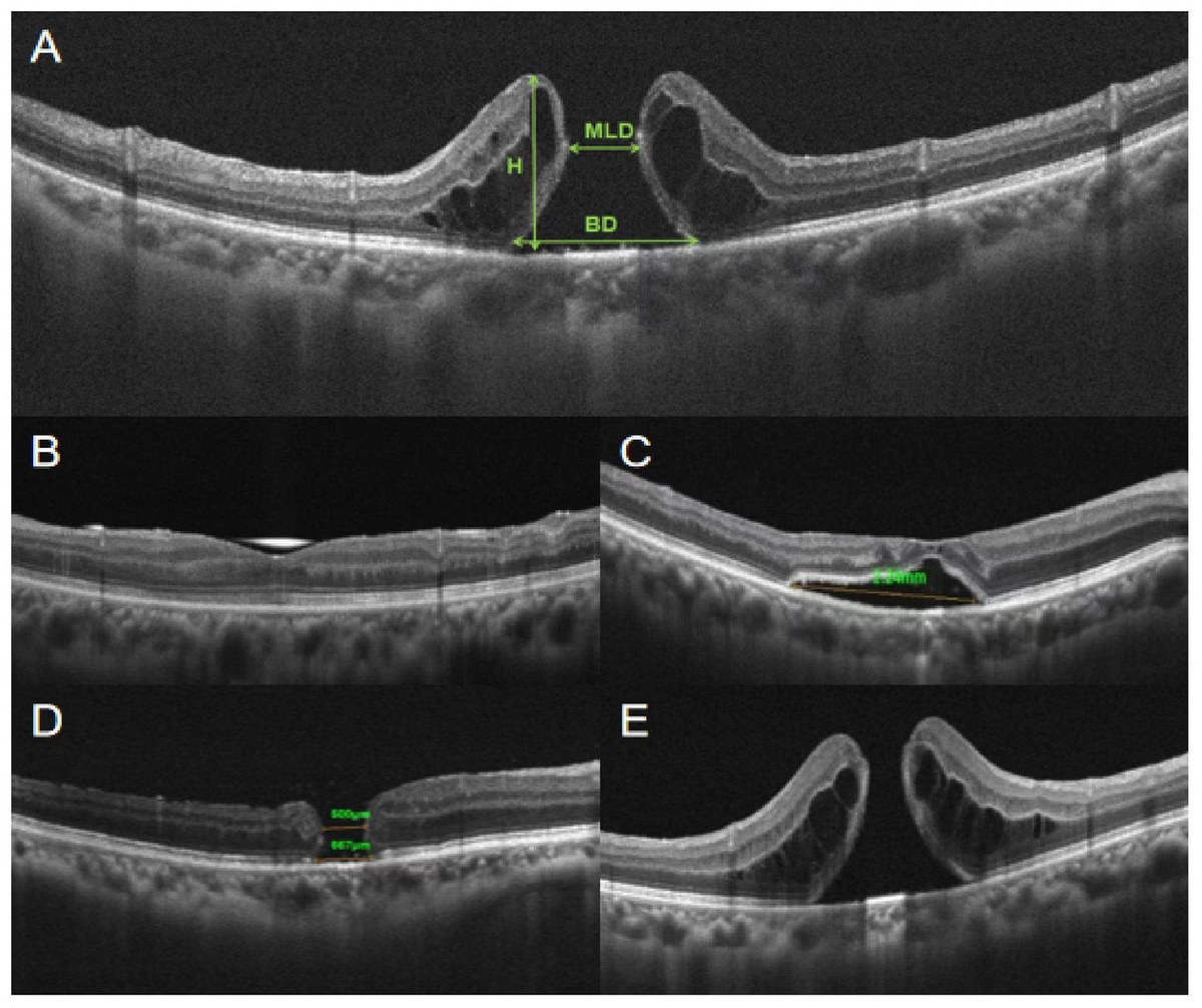 Frontiers | Outcomes of revision surgery for idiopathic
