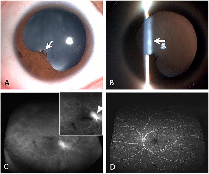 Frontiers | Case report: Ultrasound biomicroscopy as a guide