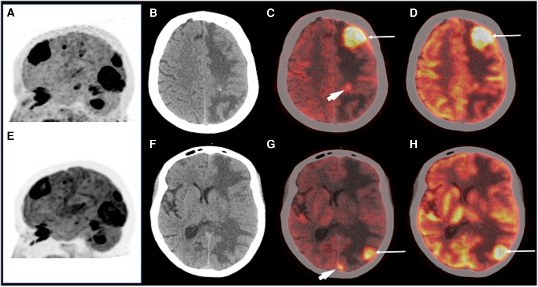 Frontiers | Tumor microenvironment and fibroblast activation protein ...