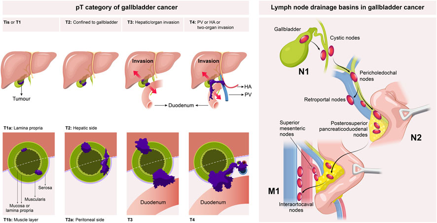 Frontiers | Gallbladder cancer: current and future treatment options