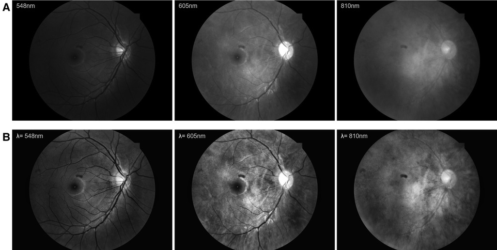 Frontiers | Predicting ischemic stroke risk from atrial