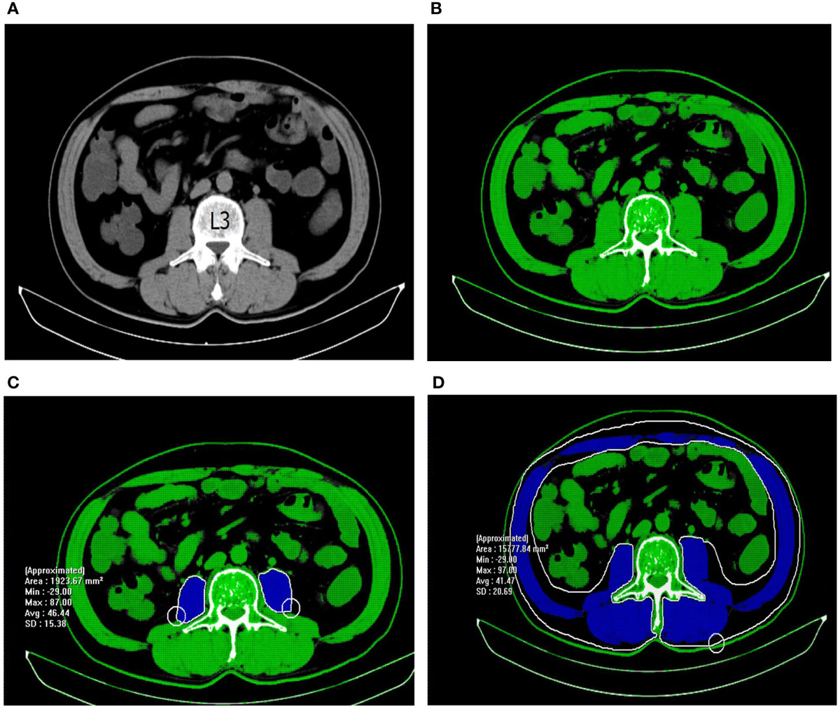 Frontiers | The psoas muscle density as a predictor of