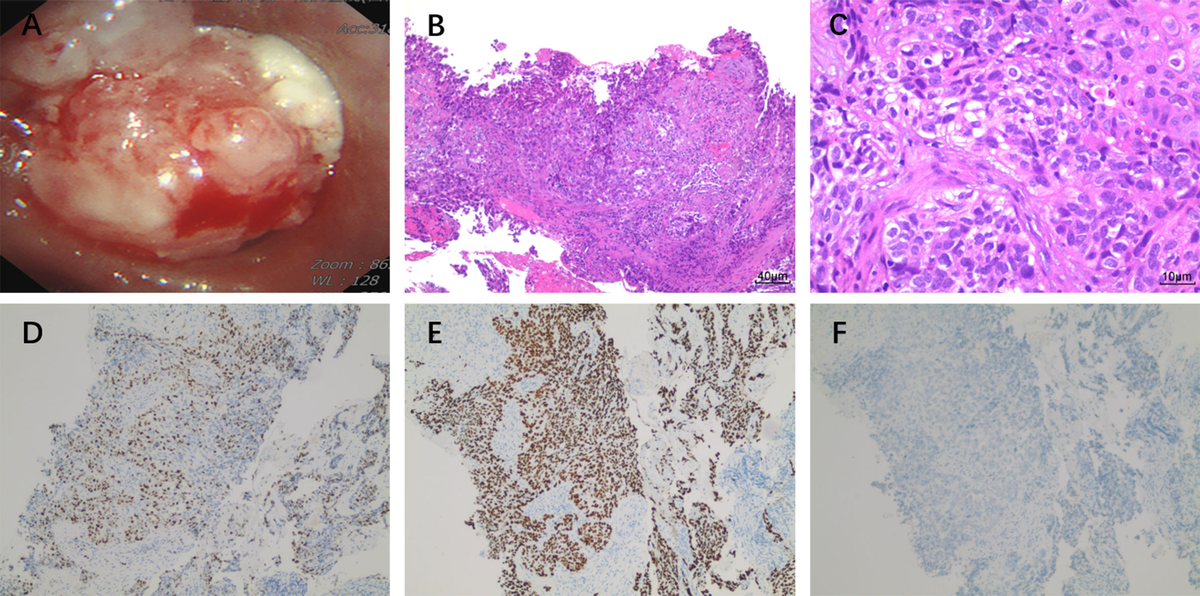 Frontiers BRCA2 mutation in advanced lung squamous cell carcinoma treated with Olaparib and a