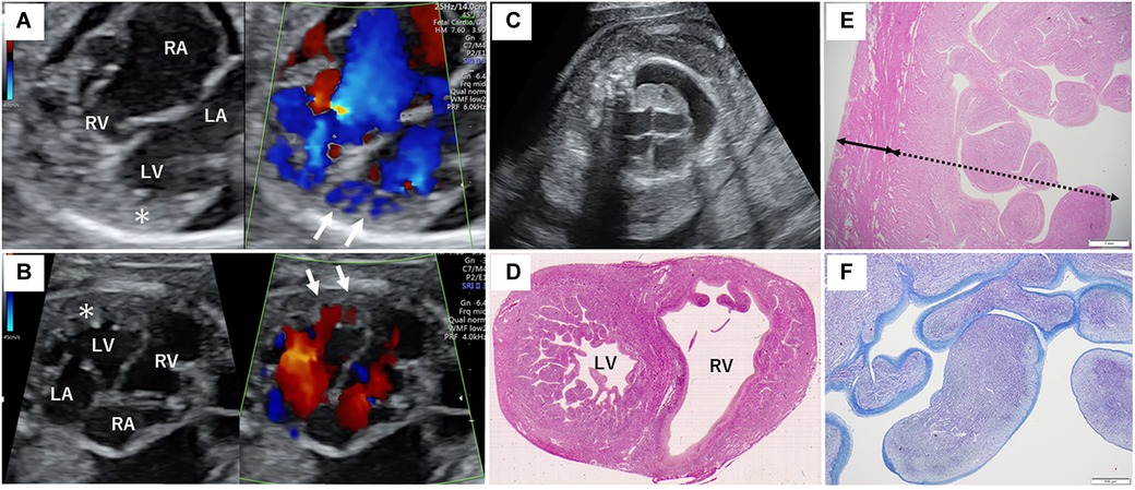 Frontiers | Low-frequency maternal novel MYH7 mosaicism