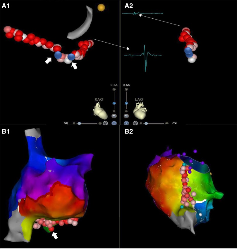 Frontiers | The effect of first step right atrial mapping (FRAM) on ...