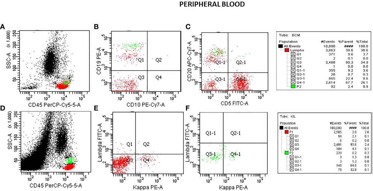 Frontiers | A case report of early diagnosis of asymptomatic hairy cell ...