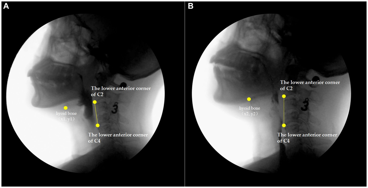 Frontiers Findings of a videofluoroscopic swallowing study in Frontiers Findings of a videofluoroscopic swallowing study in