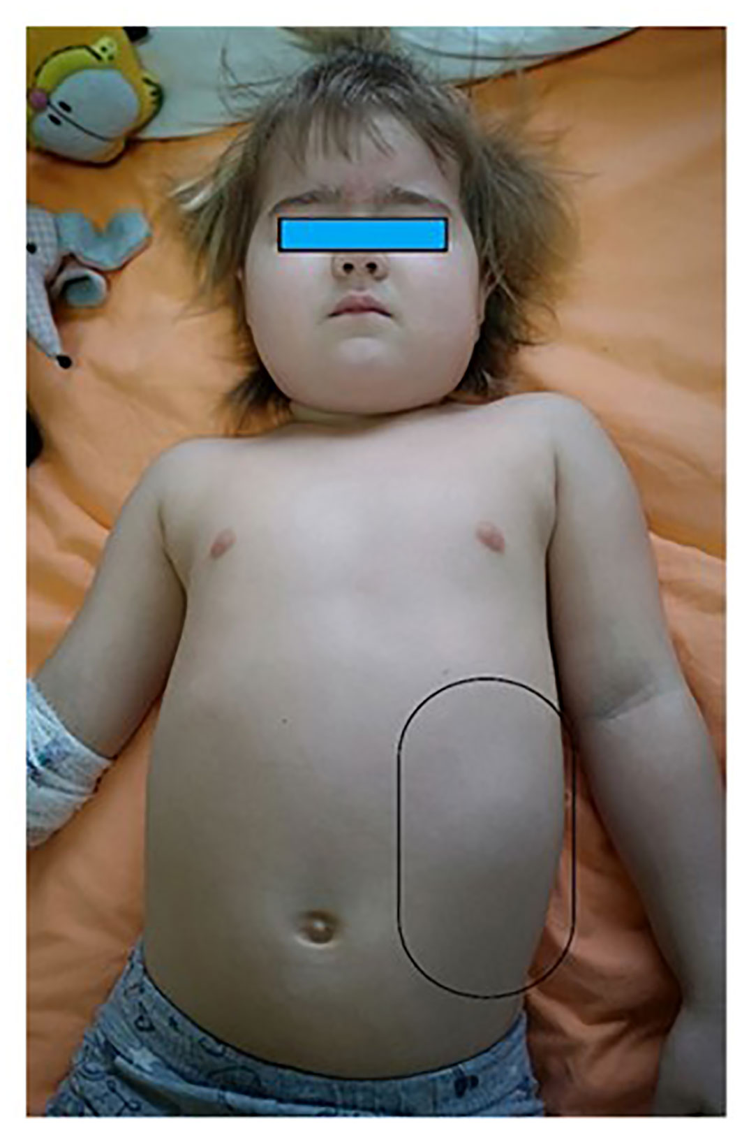 Precocious puberty boy penis　 