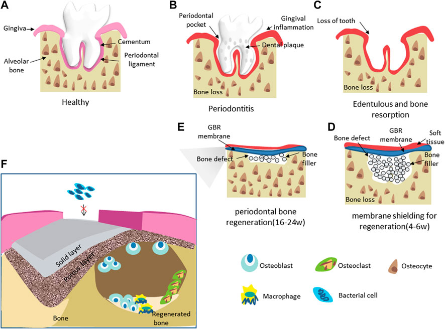 Frontiers | Barrier membranes for periodontal guided bone