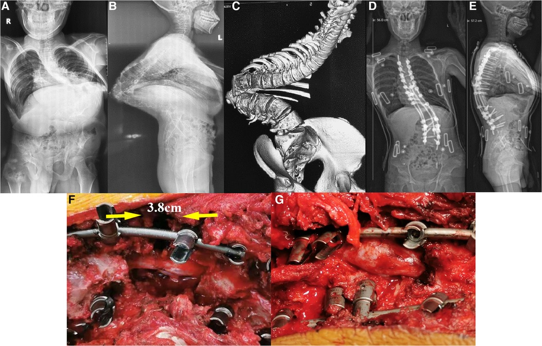 Frontiers | Postoperative dysesthesia after PVCR without