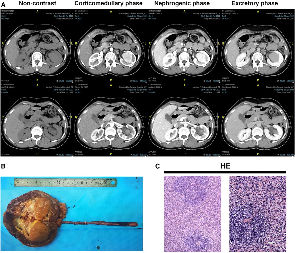 その他 123456 Apolipoprotein A1 and high-density lipoprotein limit low
