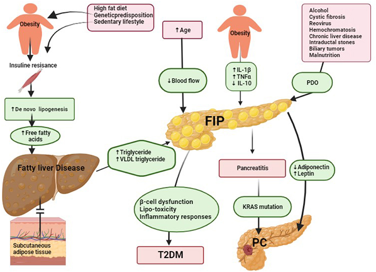 Fatty Infiltration Of Pancreas Means Frontiers | Fatty infiltration of the pancreas: a systematic concept